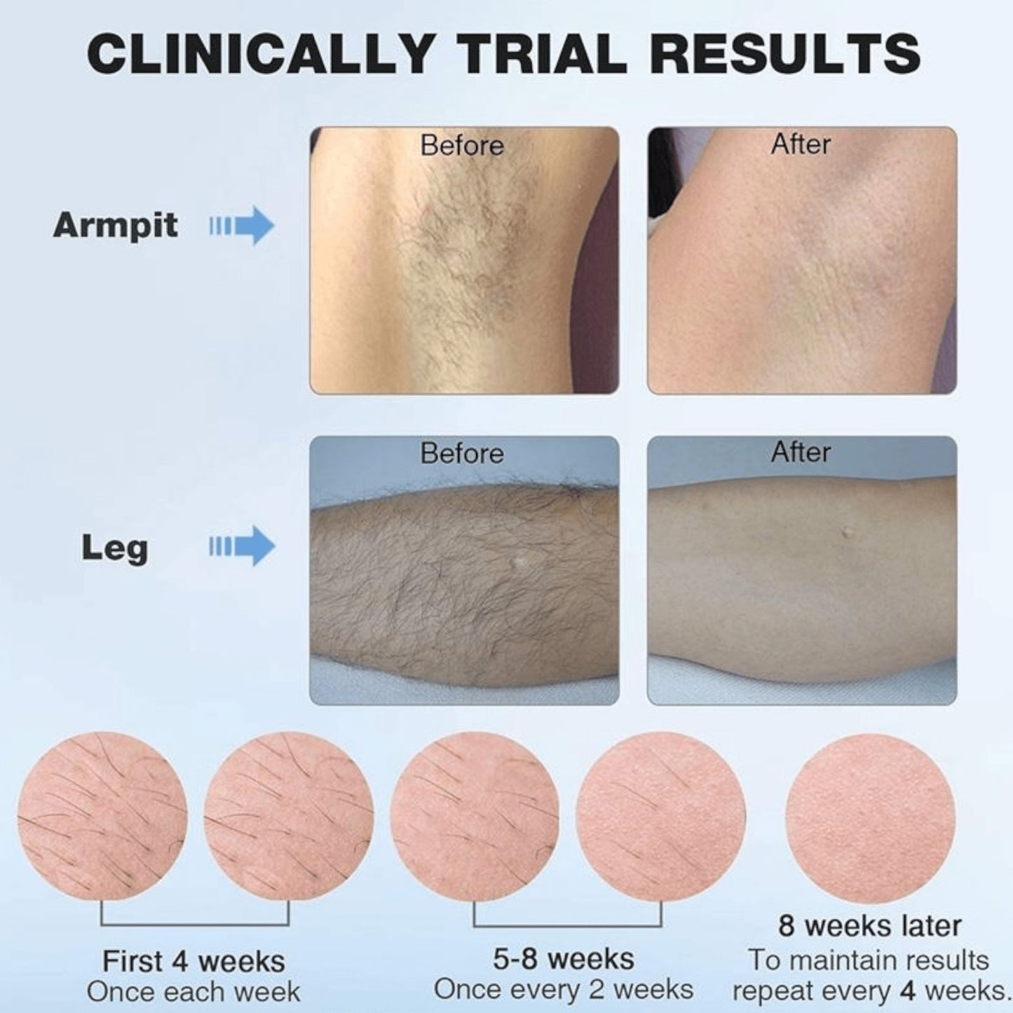 IPL uređaj za bezbolno uklanjanje dlačica